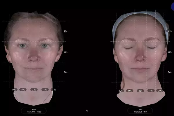 Aesthetic Enhancement: Exploring the Efficacy of XERF for Pre-Wedding Skin Rejuvenation